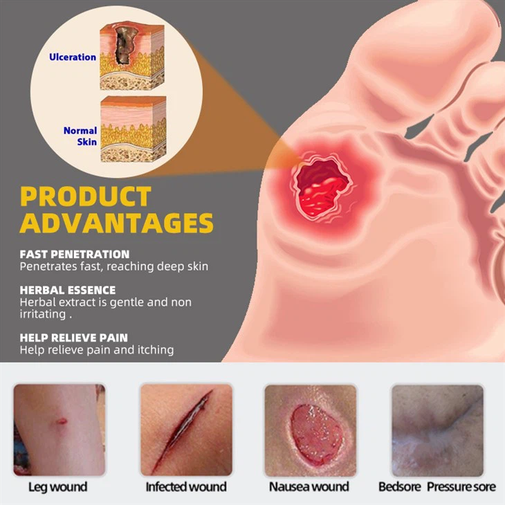 Anti-infection Bedsore Treatment Cream